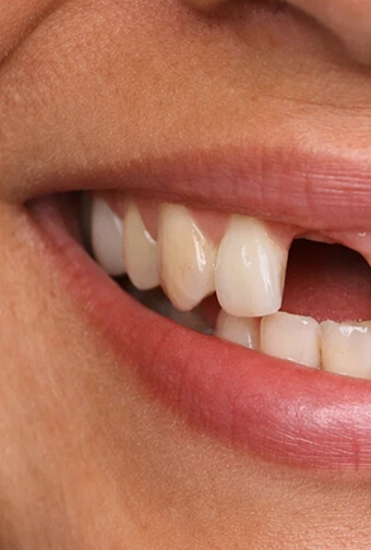 Antes rehabilitación